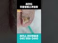 레전드 무좀발톱스케일링  #두꺼운발톱 #레푸스 #천안레푸스 #footcare #toenail #shorts