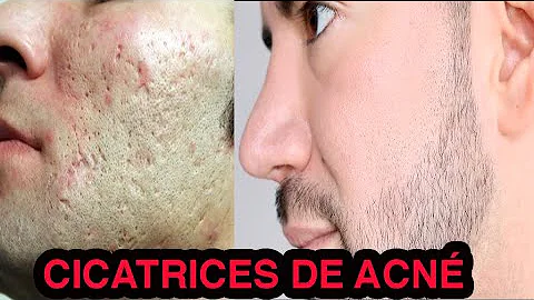 ¿Cómo puedo difuminar las cicatrices del acné de forma natural?