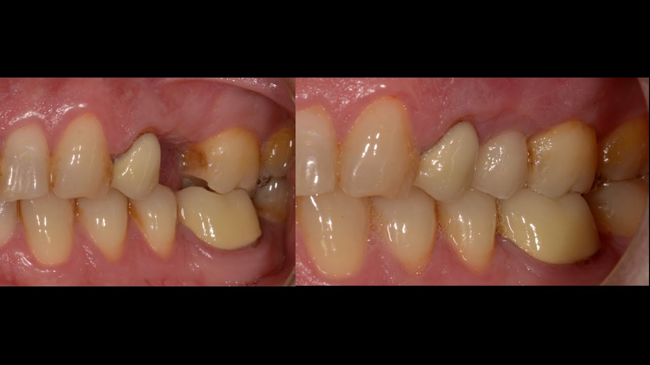 missing upper left premolar replaced with dental implant