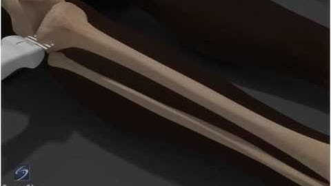 How To: Ultrasound Exam of the Tibia 3D Video