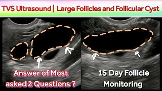 TVS Ultrasound Large Follicles and Follicular Cyst | is Large Follicle Good to Conceive ??