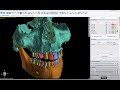 V4.12 Completely Automatic CT Teeth and Bone Segmentation in BSP