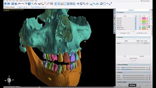 V4.12 Completely Automatic CT Teeth and Bone Segmentation in BSP
