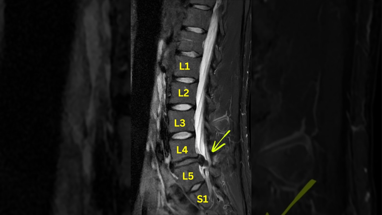 How to fix Lumbar Disc Extrusion 