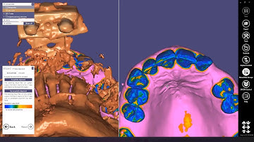 11- LIVE EXOPLAN GUIDE CREATOR and printing of the surgical guide with AccuFab D1