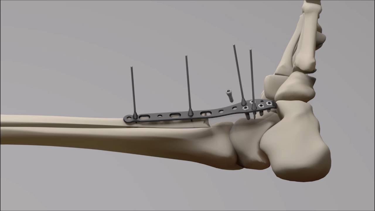 STEP™ Ankle Fracture Plating System Fibula Plate YouTube