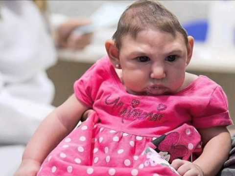 babies with microcephaly, caused by the Zika Virus ...