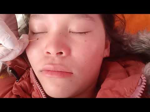 Cách Xóa Nốt Ruồi Lâu Đỏ Nhanh Khỏi 💐