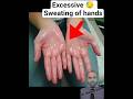 Palmar Hyperhydrosis #mbbs