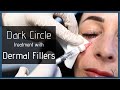 Restylane injection for under eyes  atlanta fillers  injectables  y plastic surgery