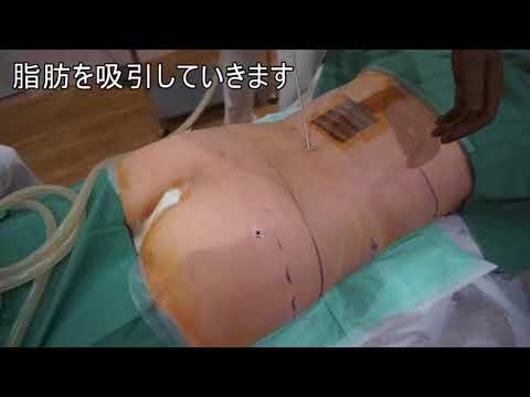 【閲覧注意｜手術動画】脂肪吸引手術の概要