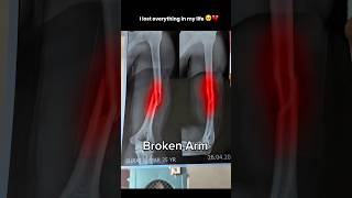 Never , lost hope 🥺❤️‍🩹 #gym #fitness #workout #motivation #inspiration #shorts #theironleg