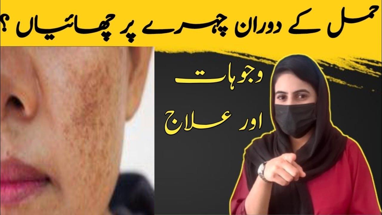 melasma-during-pregnancy-hamal-me-chaiyon-ka-ilaj-freckles-treatment