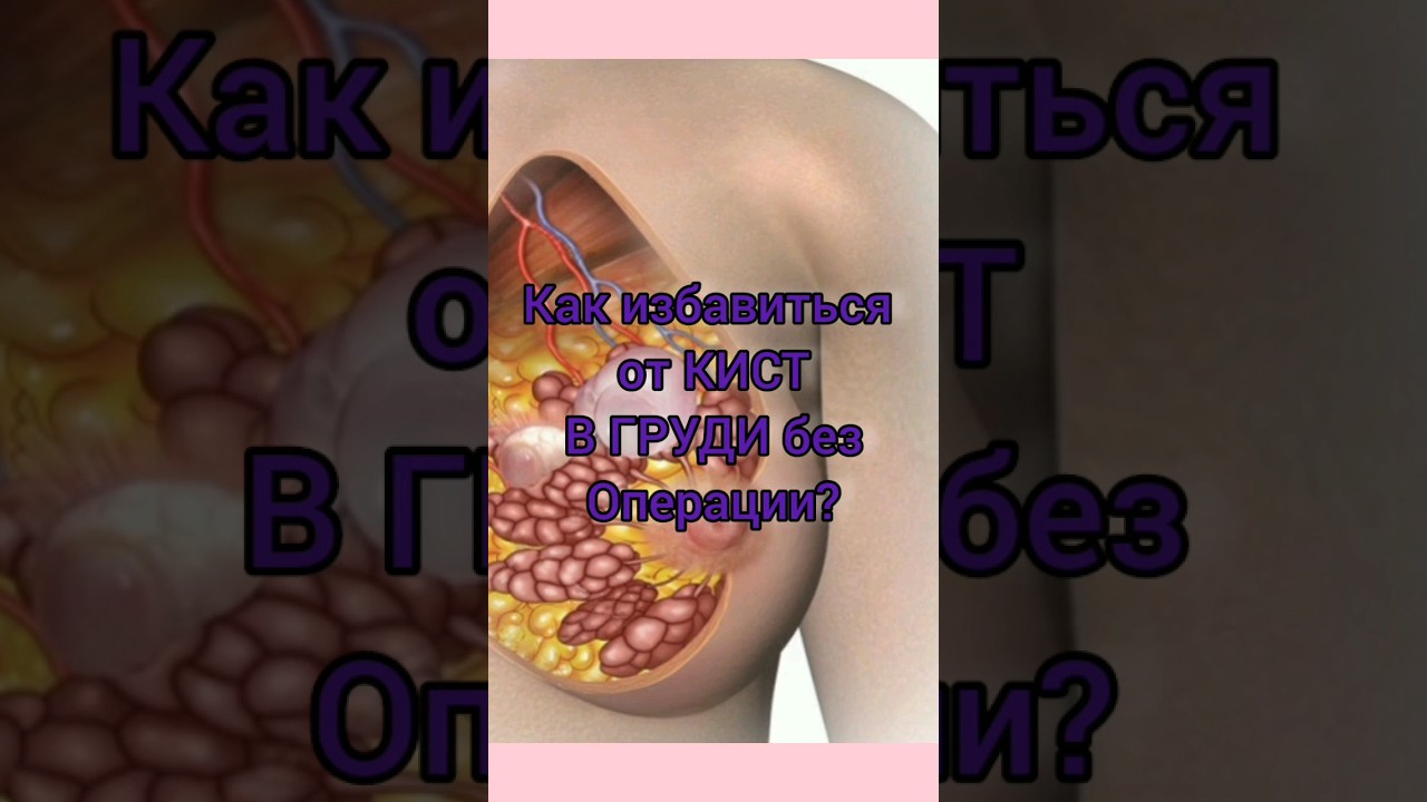 😱Избавилась от кист в груди!!! Отзыв