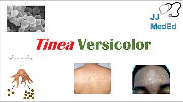 How long does pityriasis versicolor last?