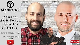 SMP Touch Up After 4 Years | Adnan Tells All #scalpmicropigmentation #hairtattoo #chicago #hairloss