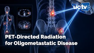PET-Directed Radiation for Oligometastatic Disease