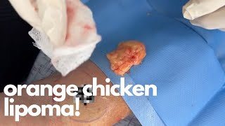 Orange Chicken Lipoma | CONTOUR DERMATOLOGY