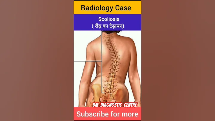 Scoliosis #radiologist #radiography #paramedical #paramedical #study #question #radiographer #xray