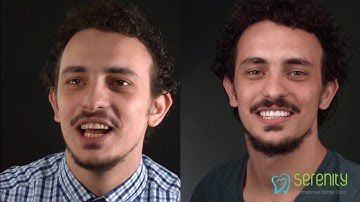 Digital Smile Design - Thiết kế nụ cười số DSD