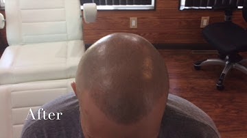 Scalp Micropigmentation by BuzzLook