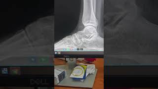 Subtalar and ankle #prp