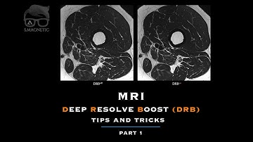 MRI DEEP RESOLVE BOOST (DRB) – TIPS & TRICKS