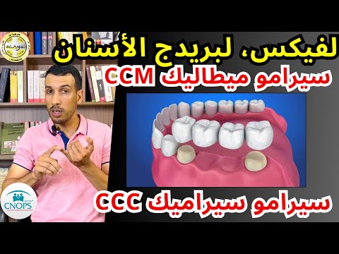 تعويض لفيكس لبريدج تغليف اسنان سيرامو سيراميك تعويض كنوبس قتيل العرق    