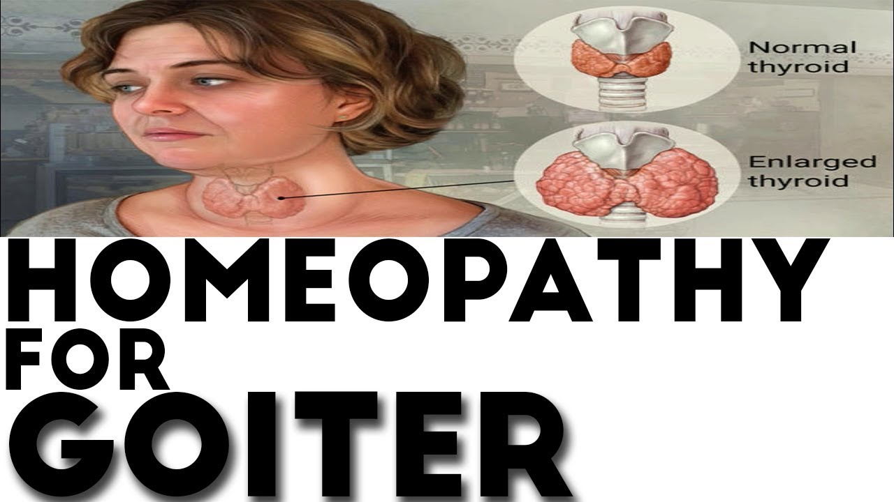 Image result for HOMOEOPATHIC REMEDIES FOR GOITRE
