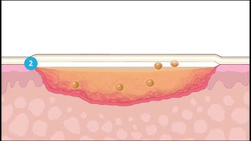 ADAPTIC™  COMO FUNCIONA