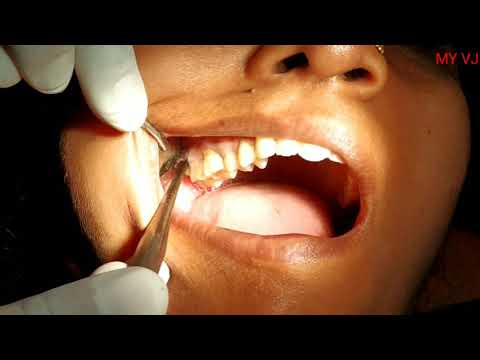 removal-of-wisdom-tooth-|-wisdom-tooth-extraction|