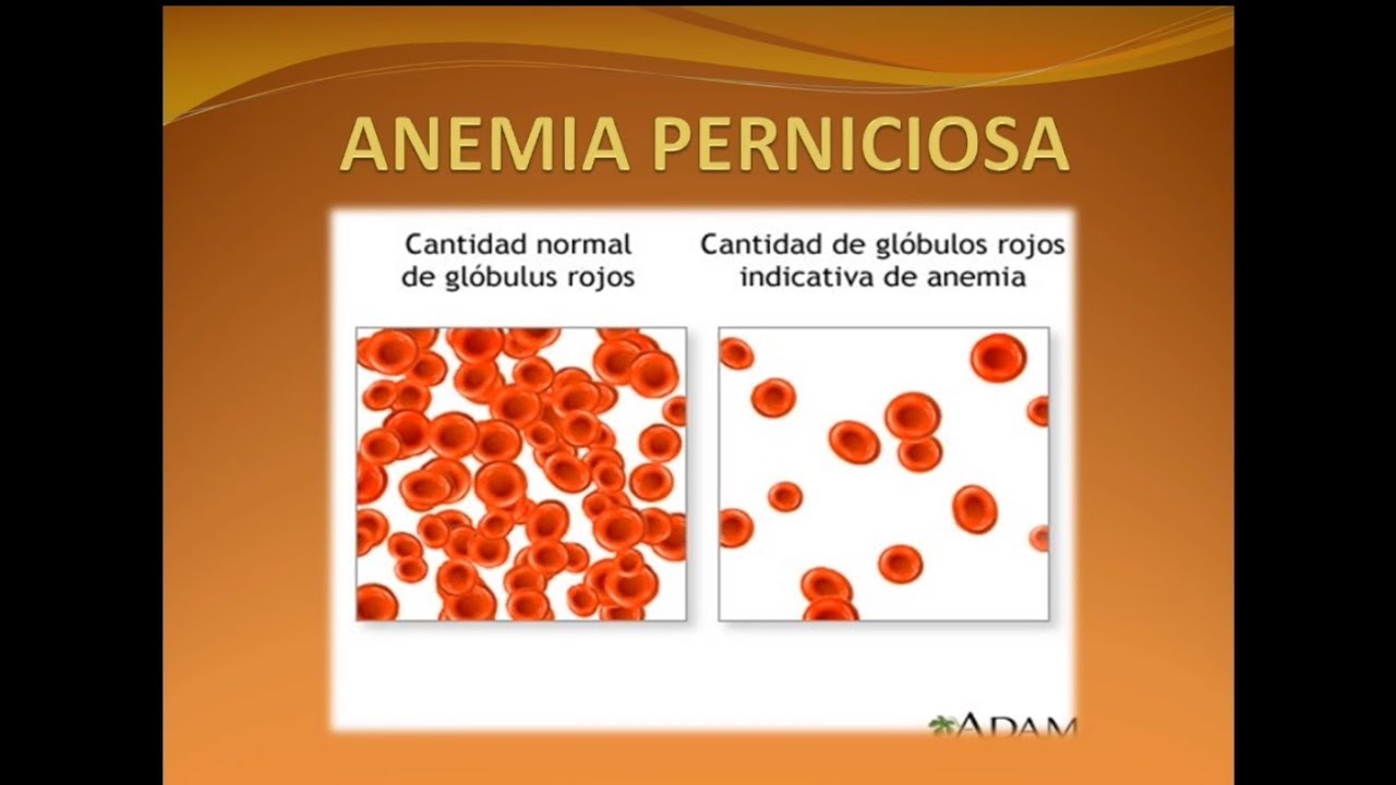 10 apa itu anemia pernisiosa Gif - Gudang Ilustrasi