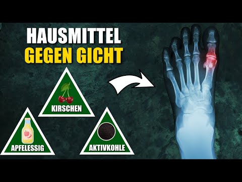 Video: 10 natürliche Möglichkeiten zur Linderung der Gelenkschmerzen Ihres Kiefers