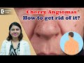 RED DOTS ON SKIN | Cherry Angioma & its Treatment | Red Moles - Dr. Amee Daxini | Doctors