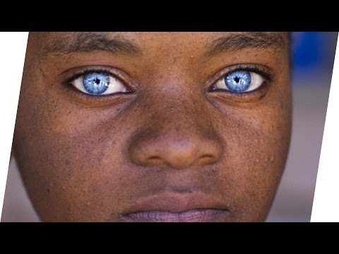 Video: Was bedeutet es, wenn Ihre Augen Perl sind?