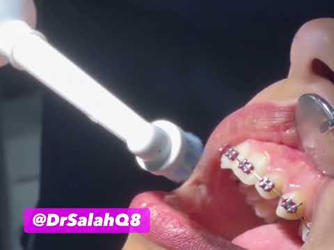 طريقة تنظيف تقويم الاسنان الاسلاك بفرشاة الاسنان الكهربائية  8