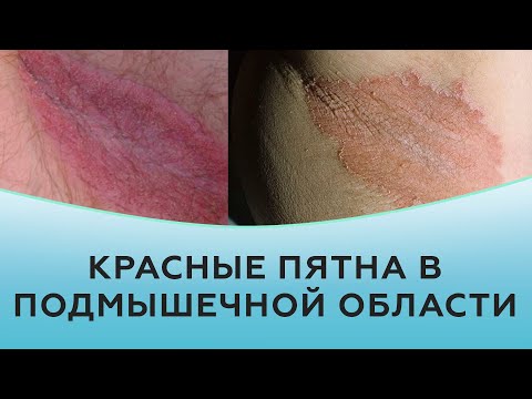 Красные пятна в подмышечной области