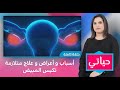 حياتي.. أسباب و أعراض و علاج متلازمة تكيس المبيض