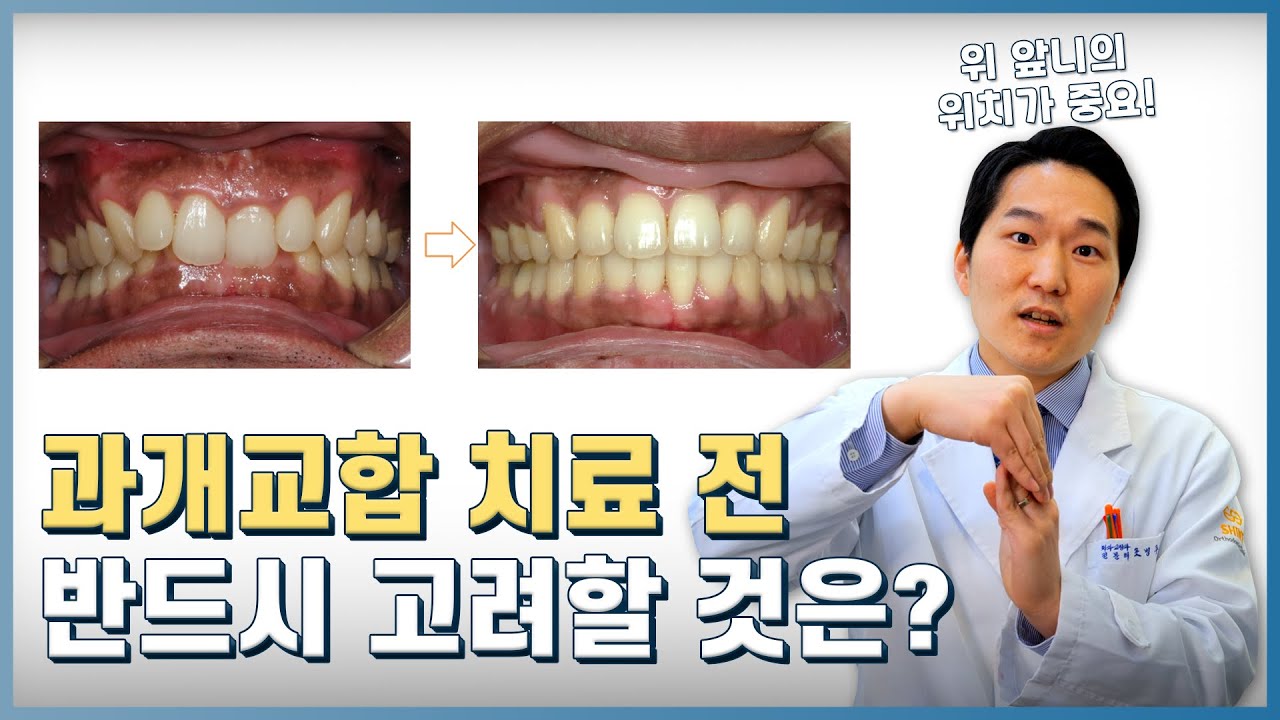 과개교합 교정 상담 전 꼭 보세요. 과개교합 교정치료에 대한 모든 것