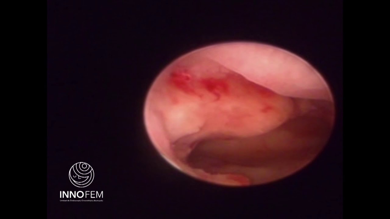 camera iphone 8 plus apk Síndrome de ovarios poliquísticos / hiperandrogenismo / enfermedad polipoidea