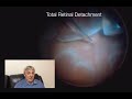 Retinal detachment surgery in tijuana  vitrectomy  dr aureliano moreno