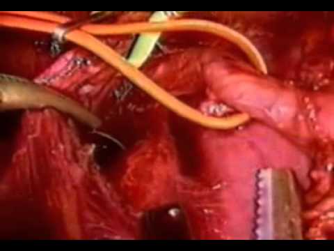 Laparoscopic D2-D3 Subtotal Gastrectomy