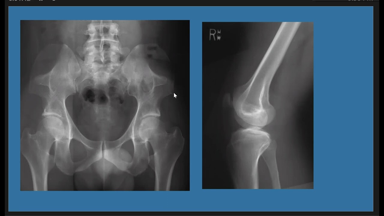 Cureus | Nail-Patella Syndrome: A Case Series From Northern India | Article