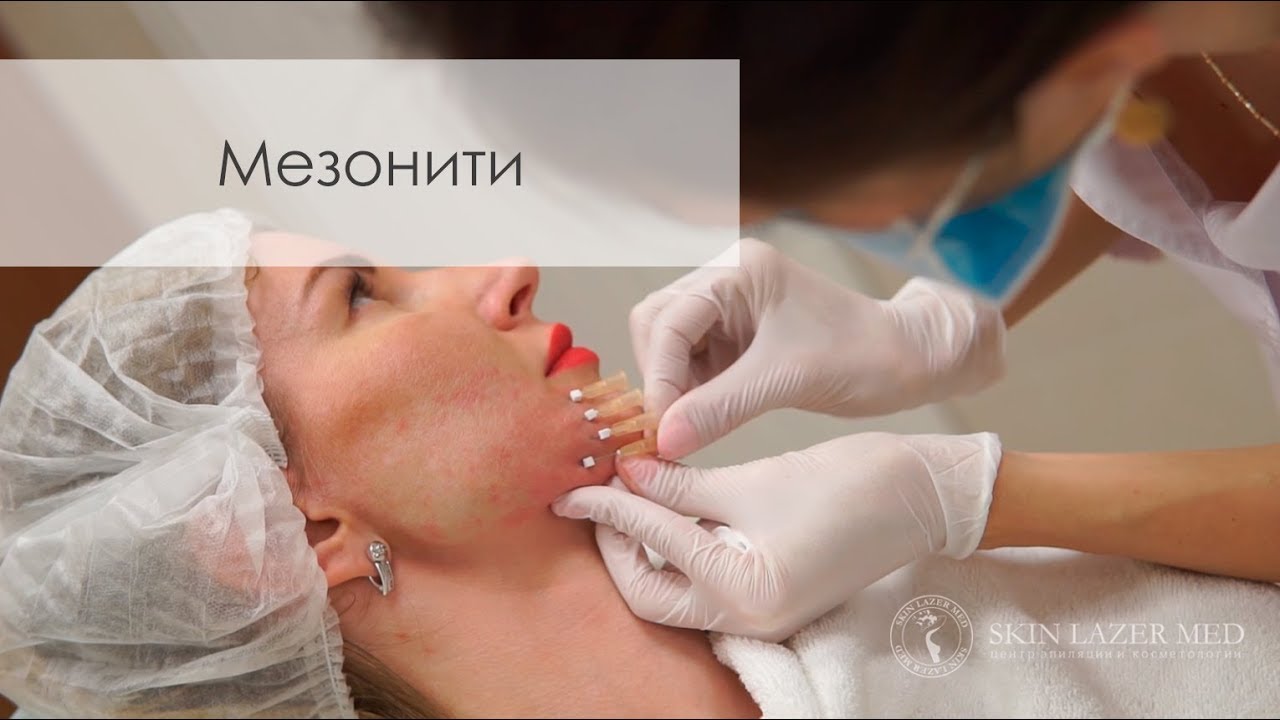 Мезонити - Нитевой лифтинг - Тредлифтинг