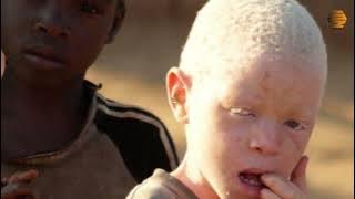 #bookreview TAKADINI na ukweli kuhusu ALBINO kuzaa ALBINO.