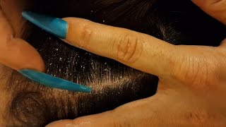 ASMR- Scalp Check for sleep-Scratching with long nails/ZOOM