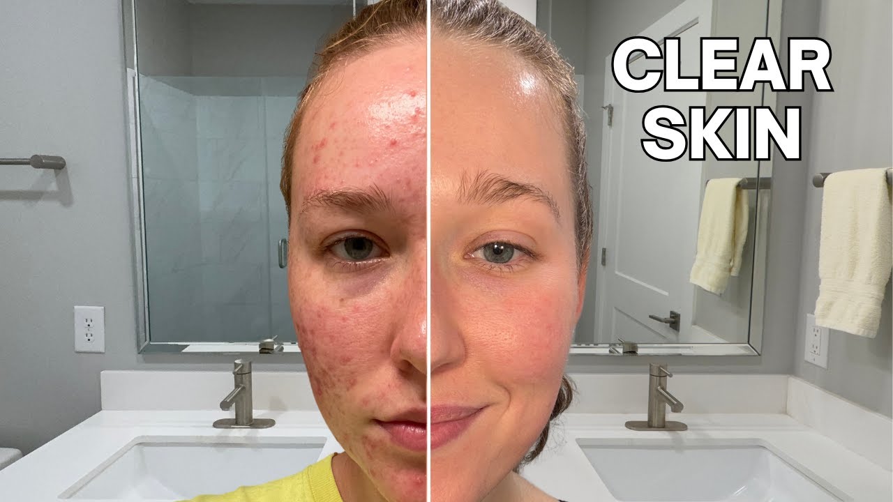 Ep. 2 - How I Got Rid of Cystic Acne in 6 Months - YouTube