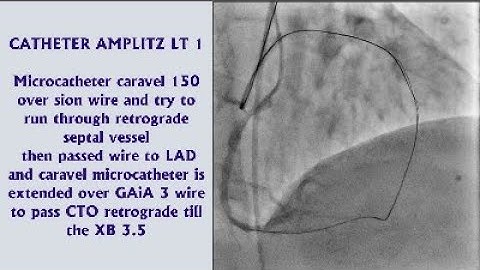 CTO Case : Retrograde approach and the second chance in CTO success