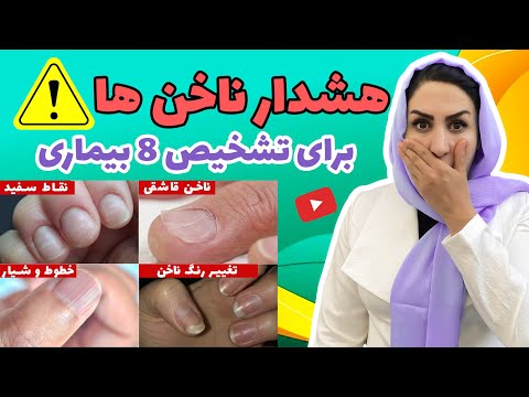 8 علامت هشداردهنده ناخن ها در مورد بیماری ها از علائم ناخن هات بیماری هاتو تشخیص بده