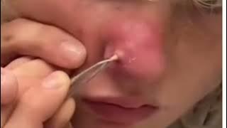 Satisfying Pencet Jerawat #satisfying #pencet #jerawat